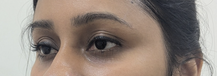 Patient 1 — after