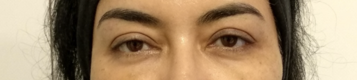 Patient 4 — after