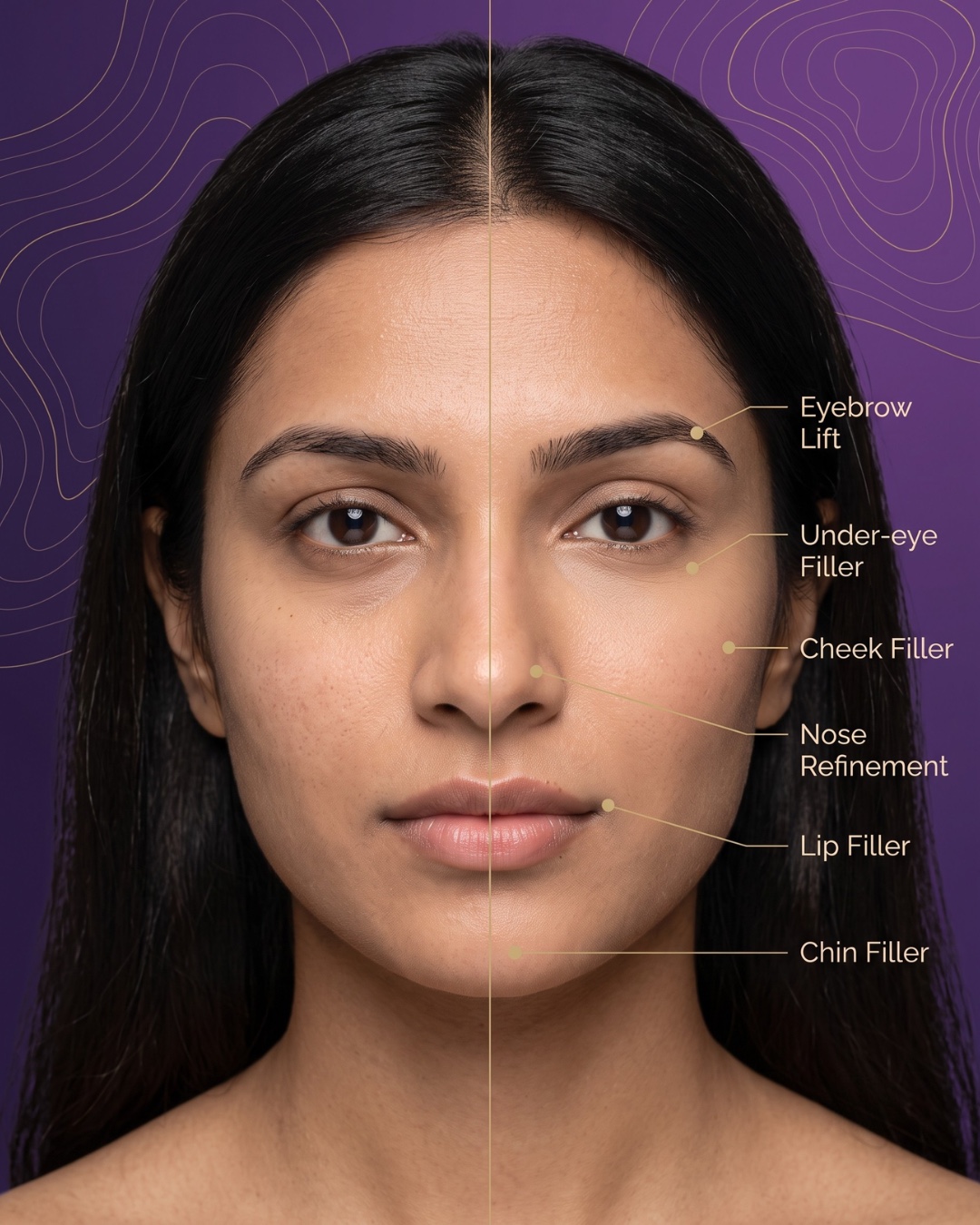 Clinic Next Face injectable treatment map on one face — eyebrow lift, under-eye, cheek, nose, lip and chin filler