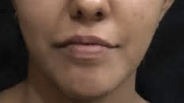 Patient 2 — after
