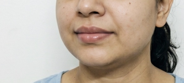 Patient 4 — after