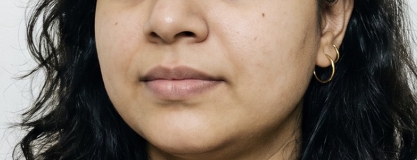 Patient 4 — before