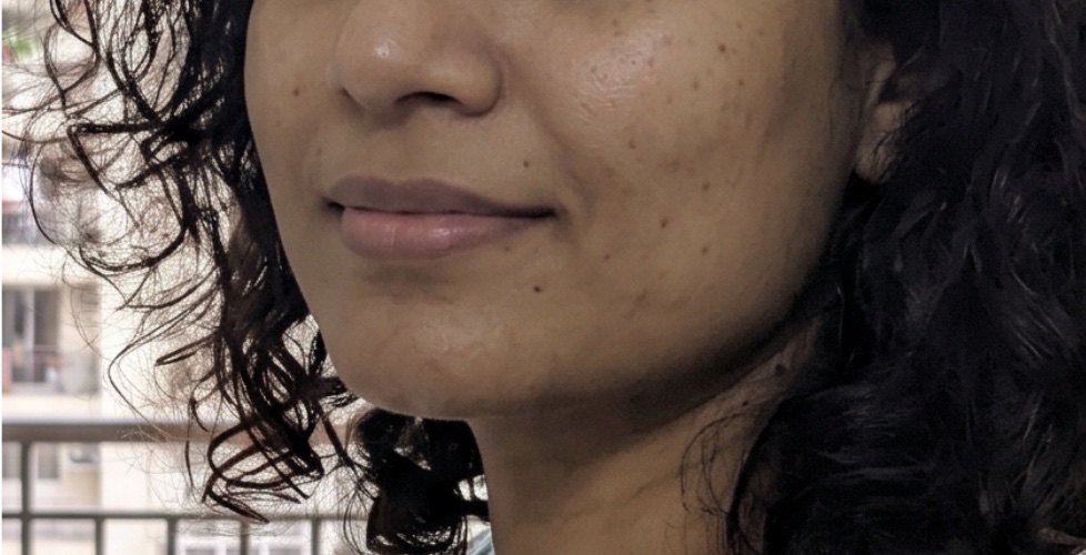 Patient 5 — before